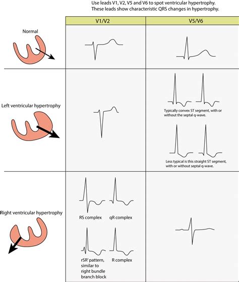 left ventricular hypertrophy nice guidelines.